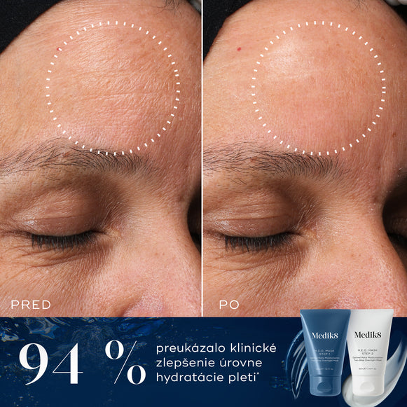 Porovnanie čela účastníka pred a po ošetrení, zobrazené vedľa tubiek Medik8 H.E.O. Mask Step 1 a Step 2. Na obrázkoch je viditeľné zníženie jemných vrások a hladšia textúra pleti. Text zdôrazňuje, že u 94 % účastníkov došlo k klinickému zlepšeniu úrovne hydratácie pokožky.-hover-45